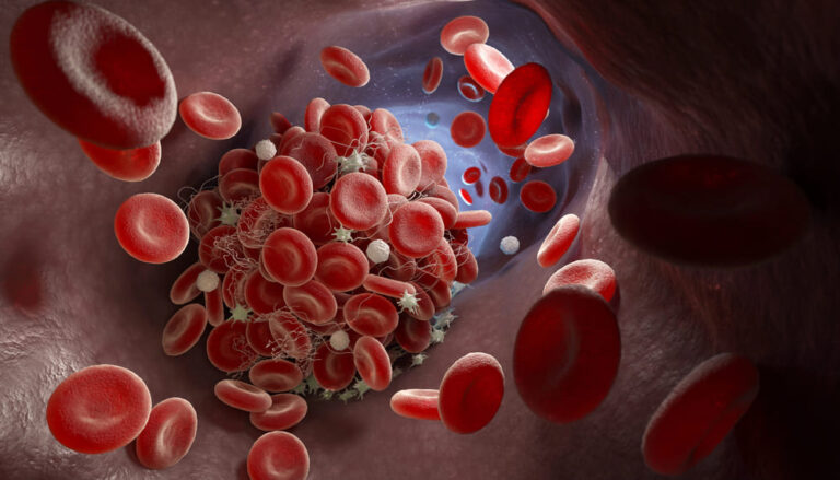 Lebenserwartung beim Antiphospholipid-Syndrom - Grund zur Sorge